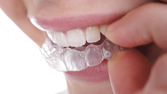 Alternatif Meratakan Gigi Selain Menggunakan Behel