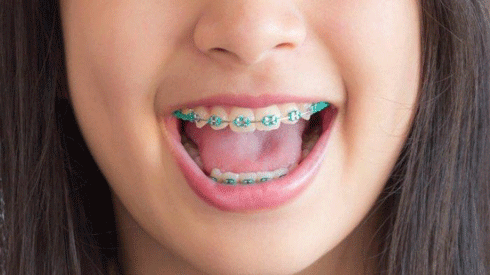 Alternatif Meratakan Gigi Selain Menggunakan Behel 